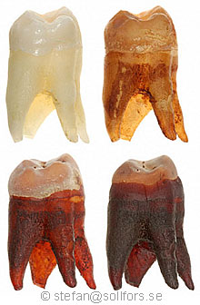 Teeth eroded by phosphoric acid in cola